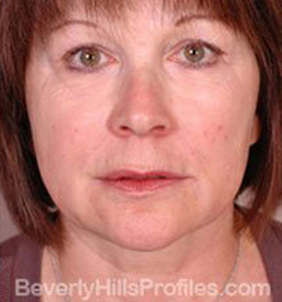 Intense Pulsed Light (IPL): After Treatment Photo - female, front view, patient 1