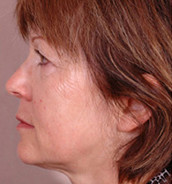 Intense Pulsed Light (IPL): Before Treatment Photo - female, left side view, patient 1