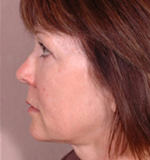 Intense Pulsed Light (IPL): After Treatment Photo - female, left side view, patient 1