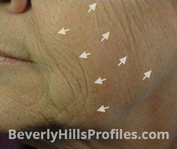 Intense Pulsed Light (IPL): Before Treatment Photo - female (cheek), oblique view, patient 2