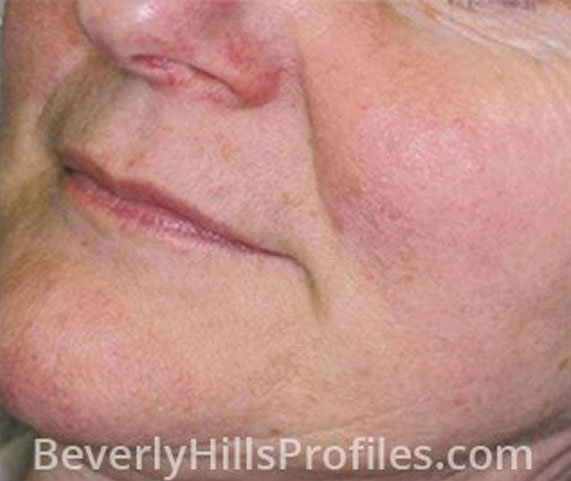 Intense Pulsed Light (IPL): After Treatment Photo - female (cheek), oblique view, patient 3