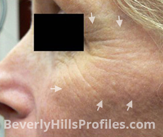 Intense Pulsed Light (IPL): Before Treatment Photo - female, left side view, patient 5