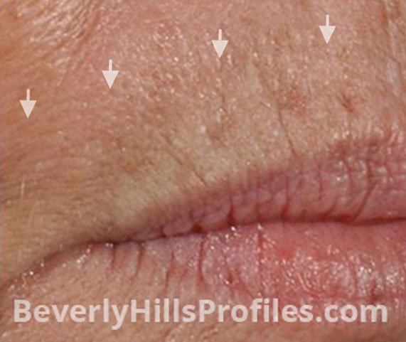 Intense Pulsed Light (IPL): Before Treatment Photo - female (lips), right side view, patient 7