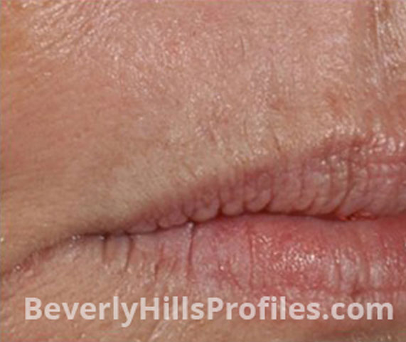 Intense Pulsed Light (IPL): After Treatment Photo - female (lips), right side view, patient 7