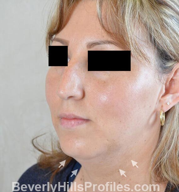 FaceLift - Before Treatment Photo - female, left side oblique view, patient 2