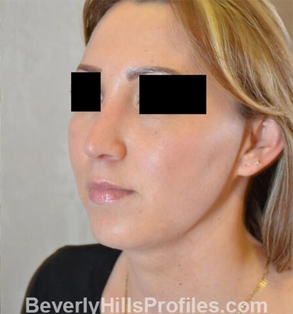 FaceLift, neck contouring surgery - After Treatment Photo - female, left side oblique view, patient 1