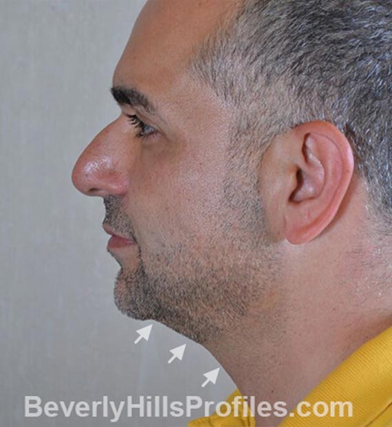 FaceLift, neck contouring surgery - Before Treatment Photo - male, left side view, patient 5