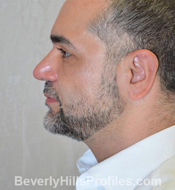 FaceLift, neck contouring surgery - After Treatment Photo - male, left side view, patient 5