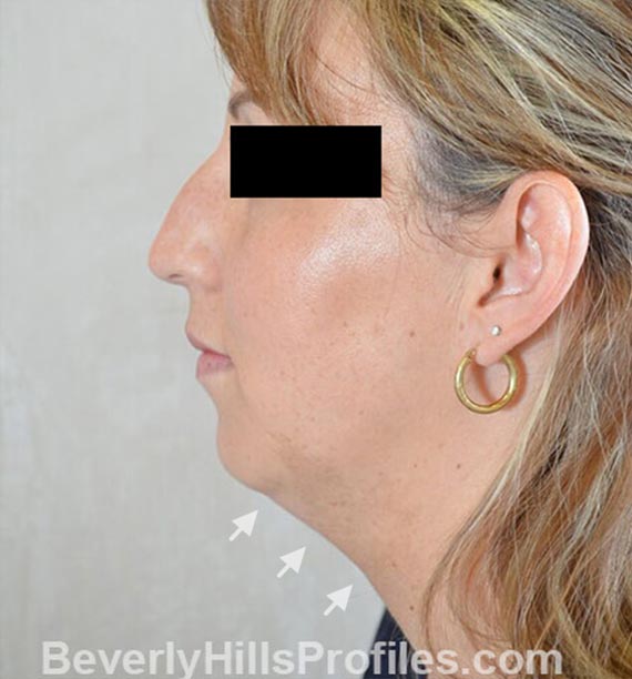 FaceLift, neck contouring surgery - Before Treatment Photo - female, left side view, patient 1