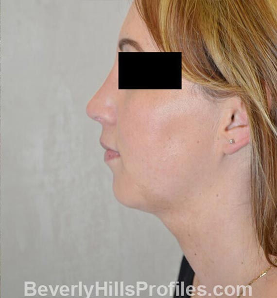 FaceLift, neck contouring surgery - After Treatment Photo - female, left side view, patient 1