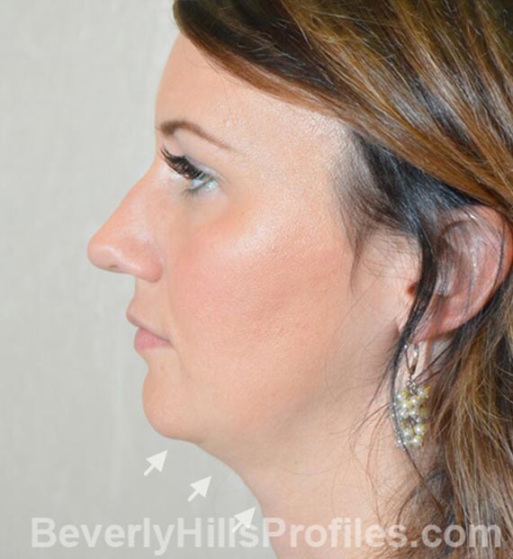 FaceLift, neck contouring surgery - Before Treatment Photo - female, left side view, patient 2