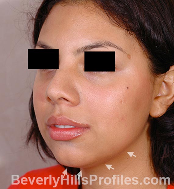 FaceLift, neck contouring surgery - Before Treatment Photo - female, left side oblique view, patient 3