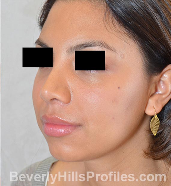 FaceLift, neck contouring surgery - After Treatment Photo - female, left side oblique view, patient 3
