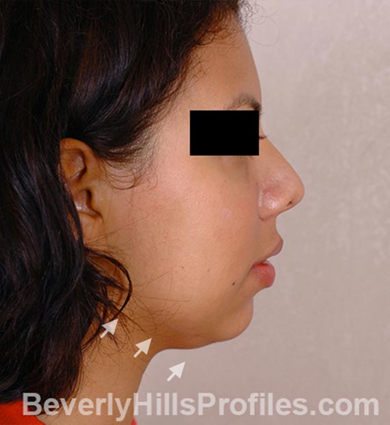 FaceLift, neck contouring surgery - Before Treatment Photo - female, right side view, patient 3