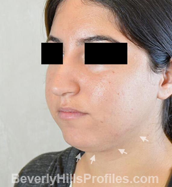 FaceLift, neck contouring surgery - Before Treatment Photo - female, left side oblique view, patient 4