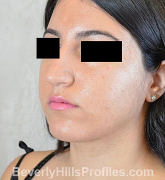 FaceLift, neck contouring surgery - After Treatment Photo - female, left side oblique view, patient 4