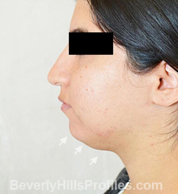 FaceLift, neck contouring surgery - Before Treatment Photo - female, left side view, patient 4