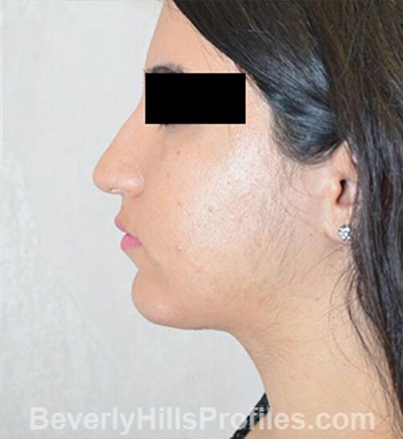 FaceLift, neck contouring surgery - After Treatment Photo - female, left side view, patient 4