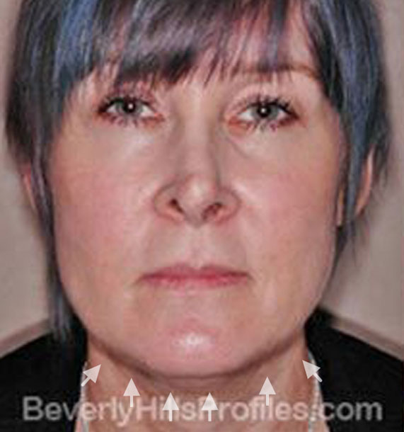 ANTI-AGING TREATMENTS IN MY 40S OR 50S - Before Treatment Photo - female, neck liposuction, front view, patient 5