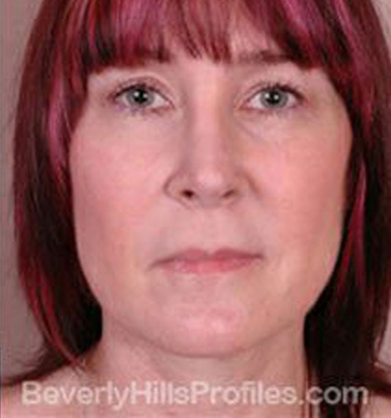 ANTI-AGING TREATMENTS IN MY 40S OR 50S - After Treatment Photo - female, neck liposuction,front view, patient 5