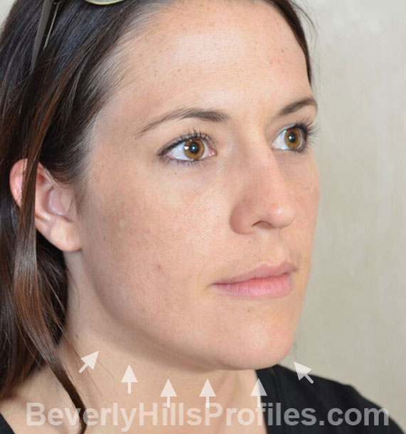 ANTI-AGING TREATMENTS IN MY 40S OR 50S - Before Treatment Photo - female, neck liposuction, oblique view, patient 9