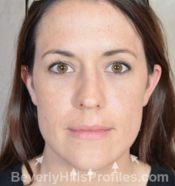 ANTI-AGING TREATMENTS IN MY 40S OR 50S - Before Treatment Photo - female, neck liposuction, front view, patient 9