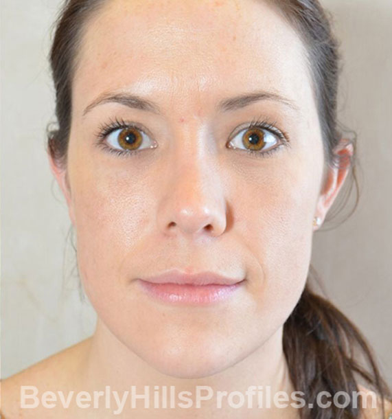 ANTI-AGING TREATMENTS IN MY 40S OR 50S - After Treatment Photo - female, neck liposuction,front view, patient 9