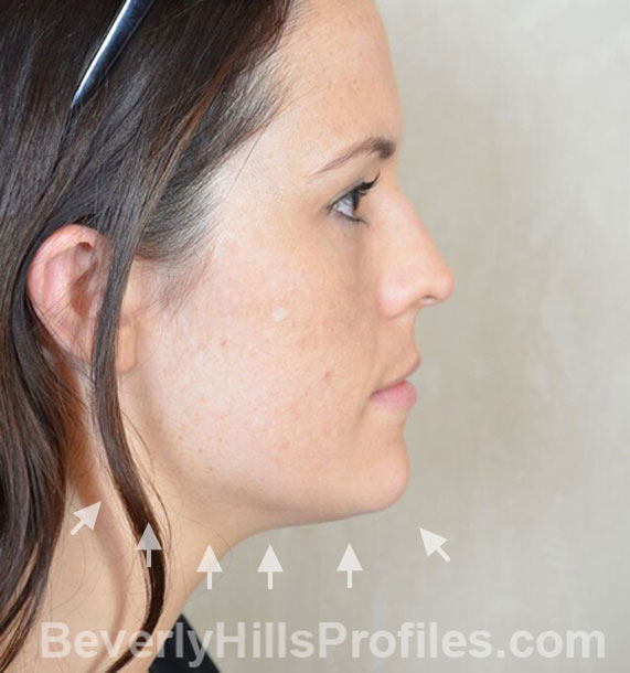 ANTI-AGING TREATMENTS IN MY 40S OR 50S - Before Treatment Photo - female, neck liposuction, right side view, patient 9