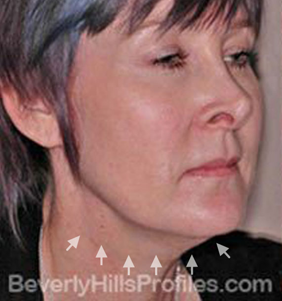 ANTI-AGING TREATMENTS IN MY 40S OR 50S - Before Treatment Photo - female, neck liposuction, oblique view, patient 5