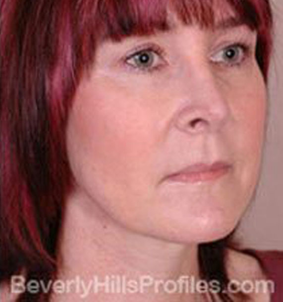 ANTI-AGING TREATMENTS IN MY 40S OR 50S - After Treatment Photo - female, neck liposuction, oblique view, patient 5