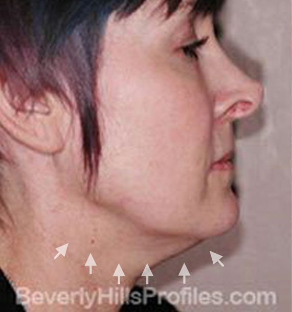 ANTI-AGING TREATMENTS IN MY 40S OR 50S - Before Treatment Photo - female, neck liposuction, right side view, patient 5