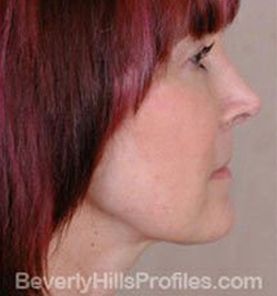 ANTI-AGING TREATMENTS IN MY 40S OR 50S - After Treatment Photo - female, neck liposuction, right side view, patient 5