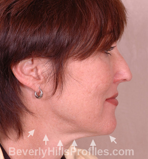 ANTI-AGING TREATMENTS IN MY 40S OR 50S - Before Treatment Photo - female, neck liposuction, right side view, patient 6