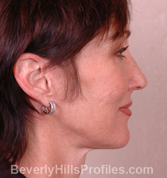 ANTI-AGING TREATMENTS IN MY 40S OR 50S - After Treatment Photo - female, neck liposuction, right side view, patient 6