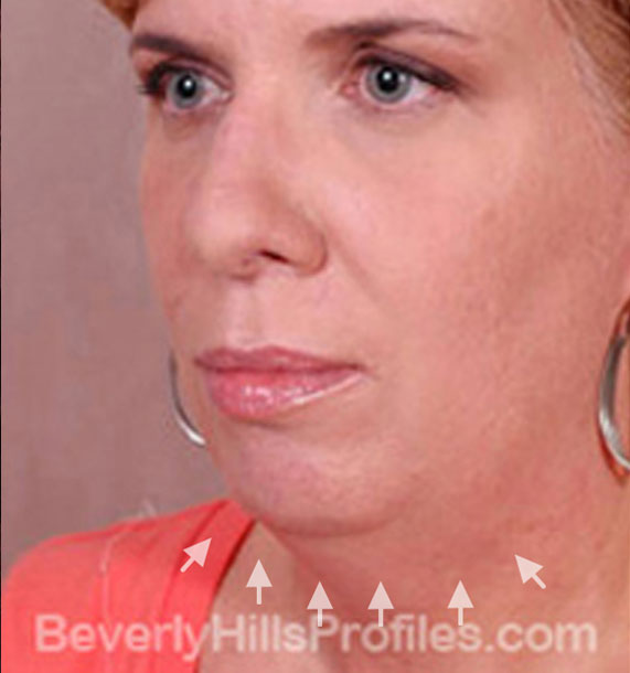 ANTI-AGING TREATMENTS IN MY 40S OR 50S - Before Treatment Photo - female, neck liposuction, oblique view, patient 7
