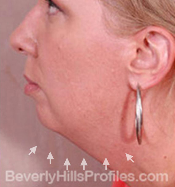 ANTI-AGING TREATMENTS IN MY 40S OR 50S - Before Treatment Photo - female, neck liposuction, left side view, patient 7