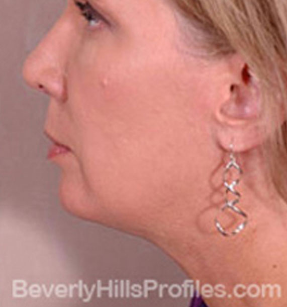 ANTI-AGING TREATMENTS IN MY 40S OR 50S - After Treatment Photo - female, neck liposuction, left side view, patient 7