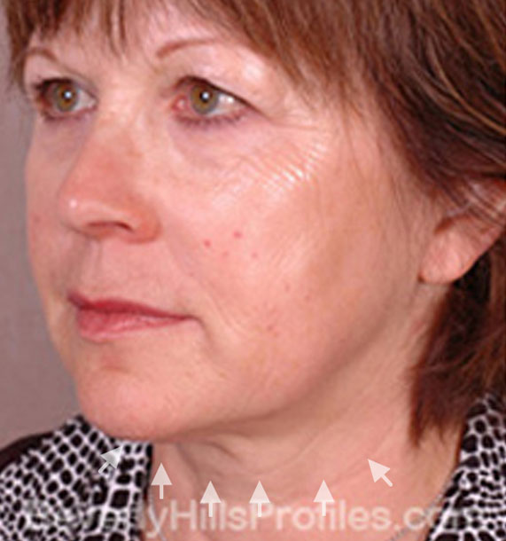 ANTI-AGING TREATMENTS IN MY 40S OR 50S - Before Treatment Photo - female, neck liposuction, oblique view, patient 8