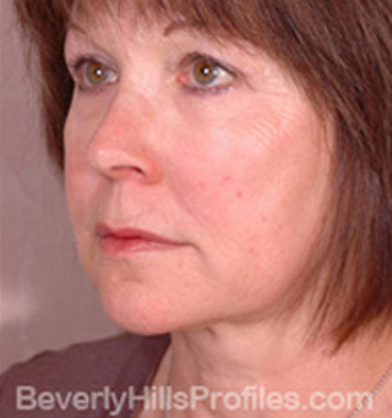 ANTI-AGING TREATMENTS IN MY 40S OR 50S - After Treatment Photo - female, neck liposuction, oblique view, patient 8