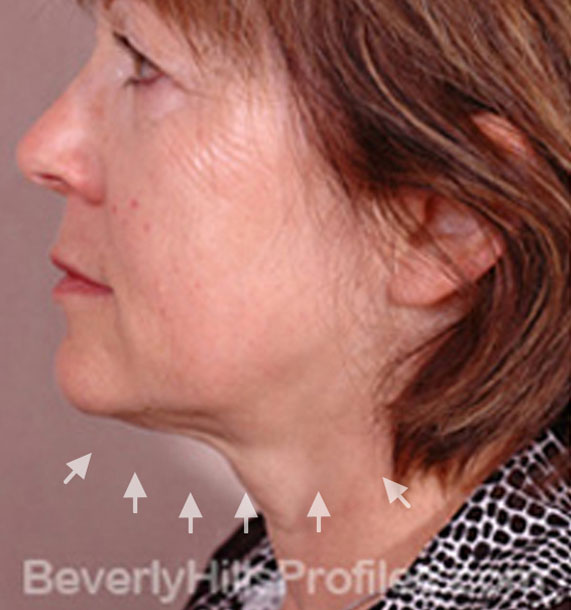 ANTI-AGING TREATMENTS IN MY 40S OR 50S - Before Treatment Photo - female, neck liposuction, left side view, patient 8