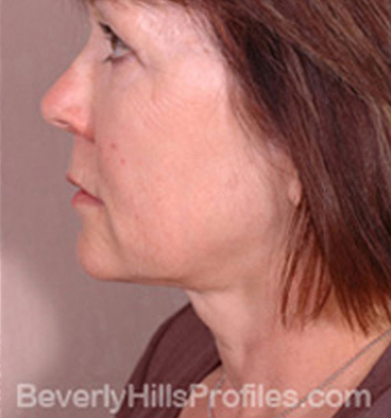 ANTI-AGING TREATMENTS IN MY 40S OR 50S - After Treatment Photo - female, neck liposuction, left side view, patient 8