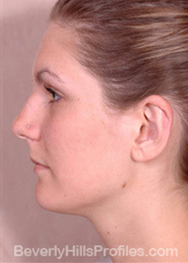 Nose Job Before - female, front view