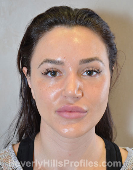 Nose Job Before - female, front view