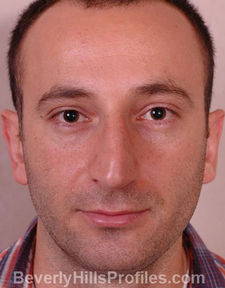 Rhinoplasty After - male, front view