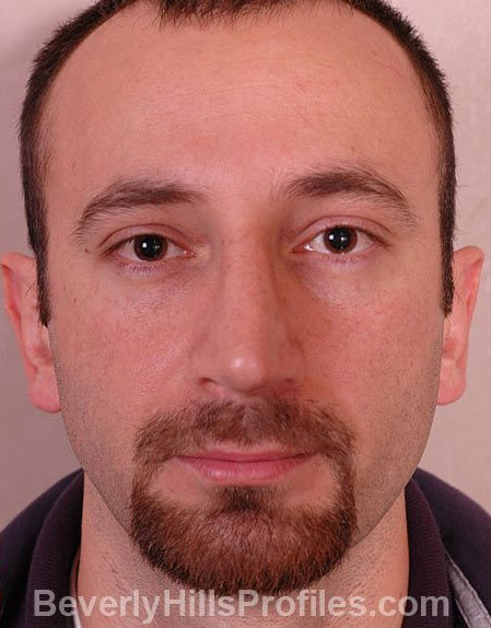 Rhinoplasty Before - male, front view