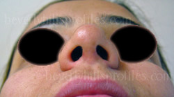 before Open Rhinoplasty