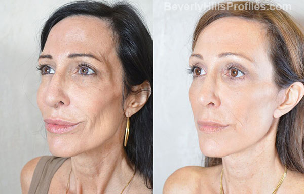 Female face, before and after Browlift treatment, oblique view, patient 1