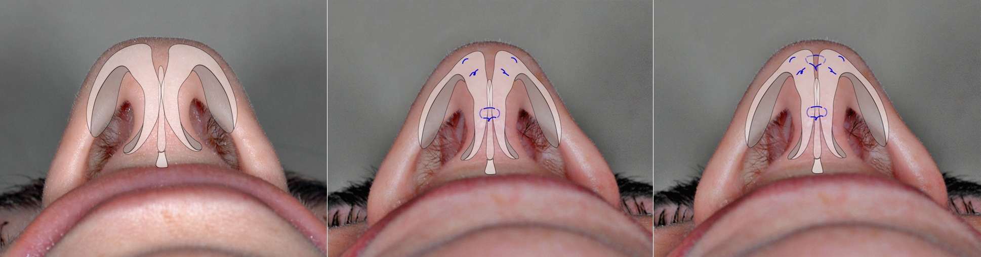 Suture techniques for tip narrowing and refinement