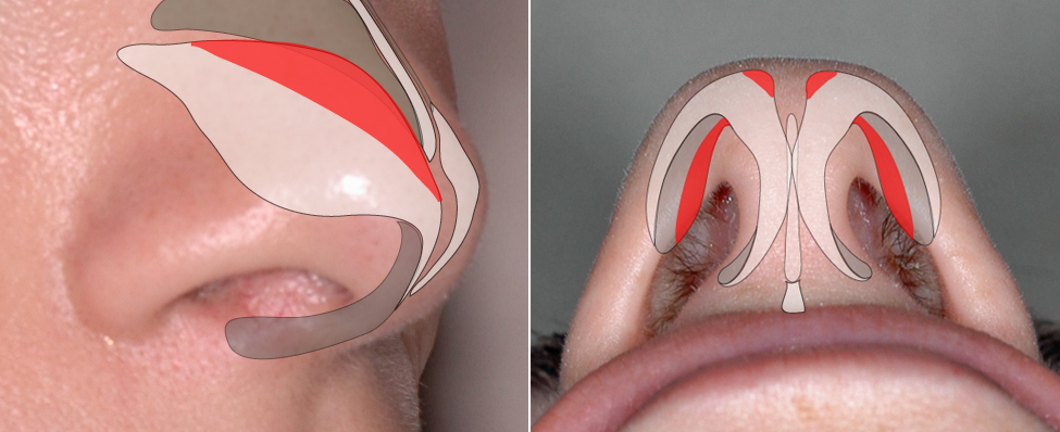 Cephalic trim technique for narrowing a wide tip