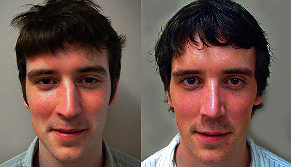 before and after cosmetic rhinoplasty